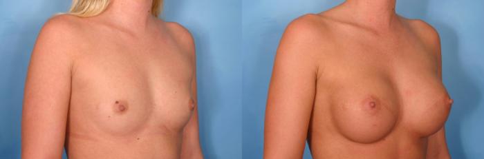 Before & After Breast Augmentation Case 68 View #1 View in Naples and Ft. Myers, FL