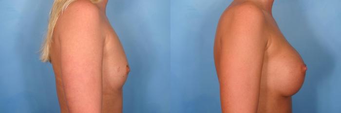 Before & After Breast Augmentation Case 68 View #2 View in Naples and Ft. Myers, FL