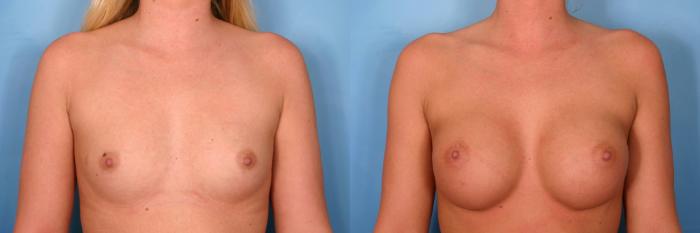 Before & After Breast Augmentation Case 68 View #3 View in Naples and Ft. Myers, FL