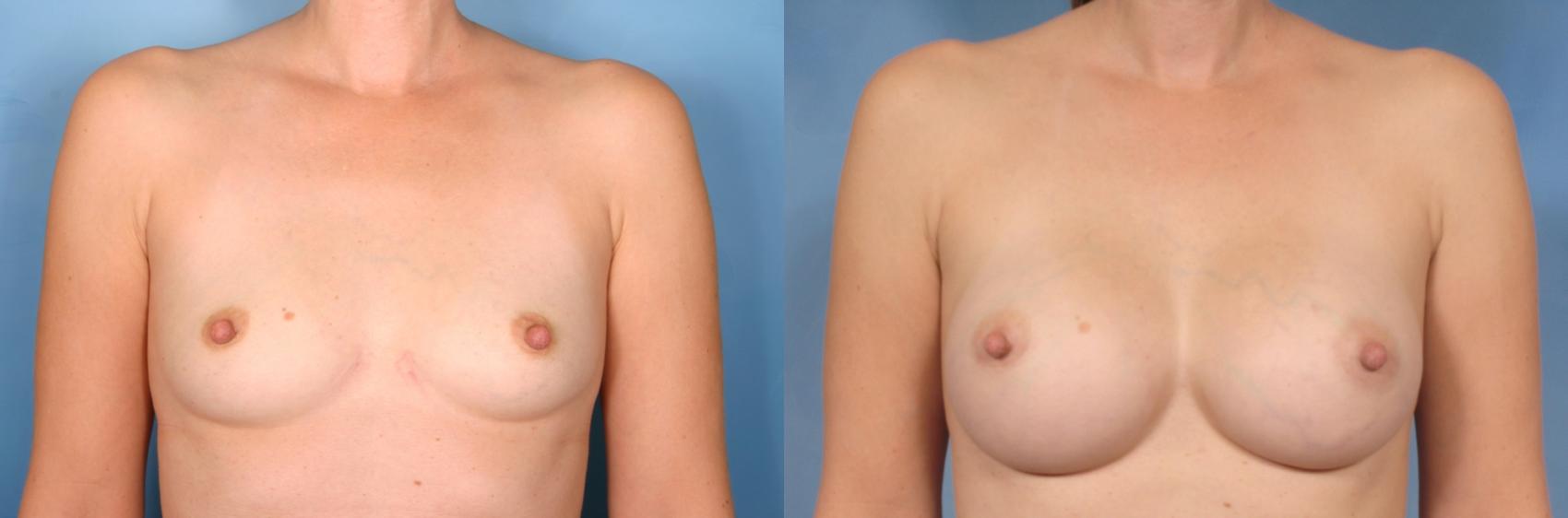 Before & After Breast Augmentation Case 76 View #2 View in Naples and Ft. Myers, FL