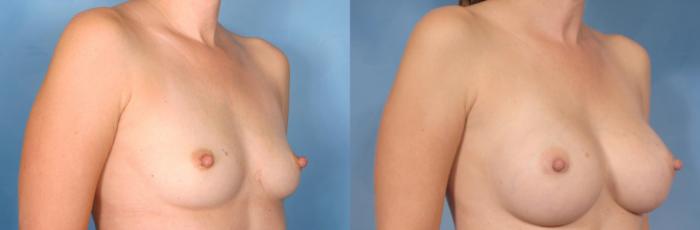 Before & After Breast Augmentation Case 76 View #5 View in Naples and Ft. Myers, FL