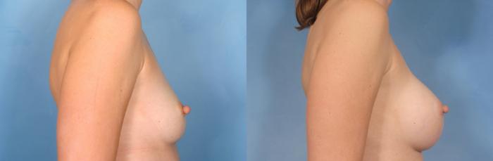 Before & After Breast Augmentation Case 76 View #6 View in Naples and Ft. Myers, FL