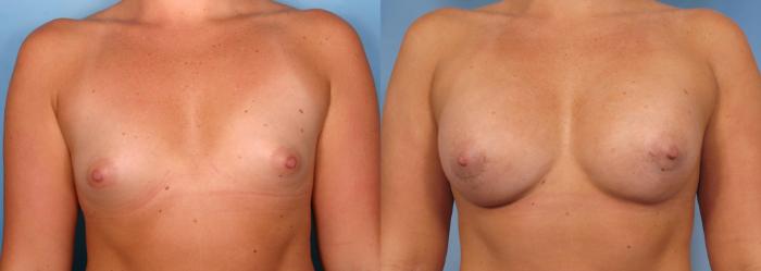 Before & After Breast Augmentation Case 88 View #1 View in Naples and Ft. Myers, FL