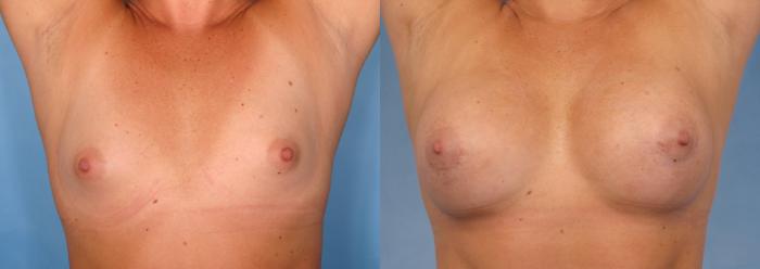 Before & After Breast Augmentation Case 88 View #2 View in Naples and Ft. Myers, FL