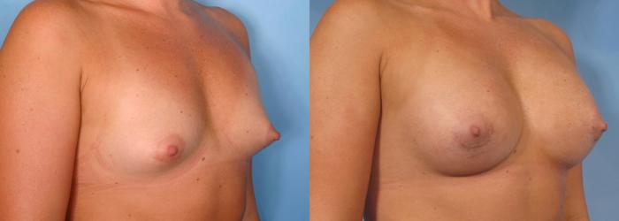 Before & After Breast Augmentation Case 88 View #3 View in Naples and Ft. Myers, FL