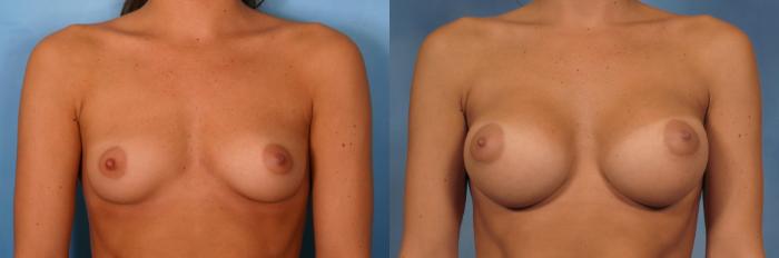 Before & After Breast Augmentation Case 95 View #1 View in Naples and Ft. Myers, FL