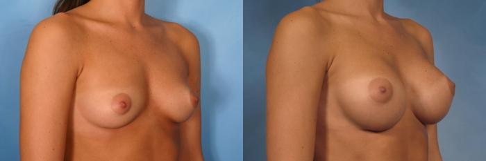 Before & After Breast Augmentation Case 95 View #2 View in Naples and Ft. Myers, FL