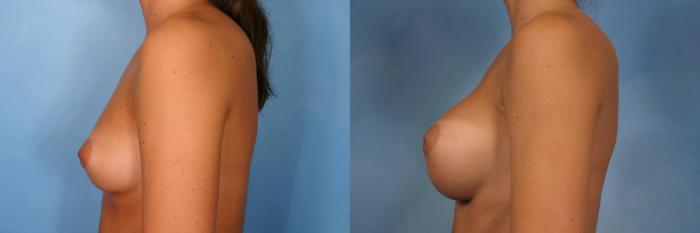 Before & After Breast Augmentation Case 95 View #3 View in Naples and Ft. Myers, FL