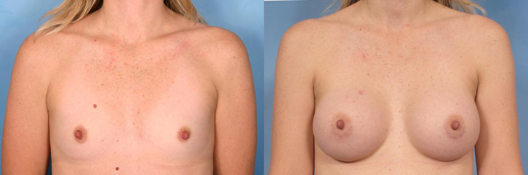 Before & After Breast Augmentation Case 96 View #1 View in Naples and Ft. Myers, FL