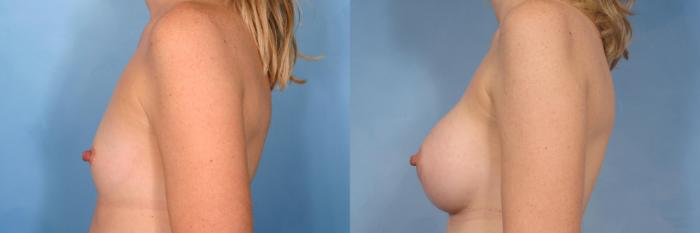 Before & After Breast Augmentation Case 96 View #2 View in Naples and Ft. Myers, FL