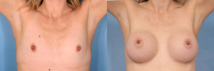 Before & After Breast Augmentation Case 96 View #3 View in Naples and Ft. Myers, FL