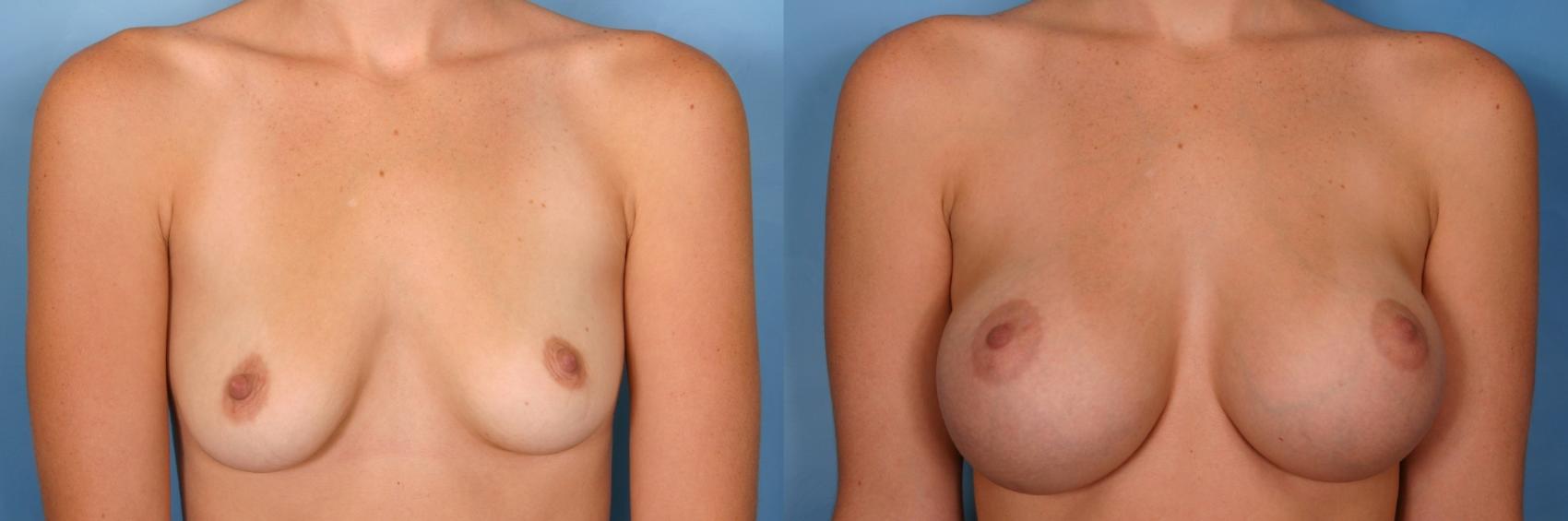 Before & After Breast Augmentation Case 97 View #1 View in Naples and Ft. Myers, FL