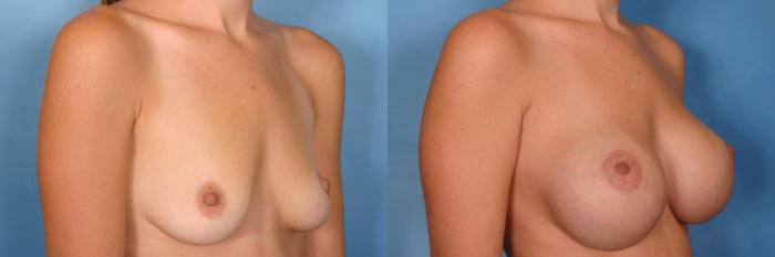 Before & After Breast Augmentation Case 97 View #2 View in Naples and Ft. Myers, FL