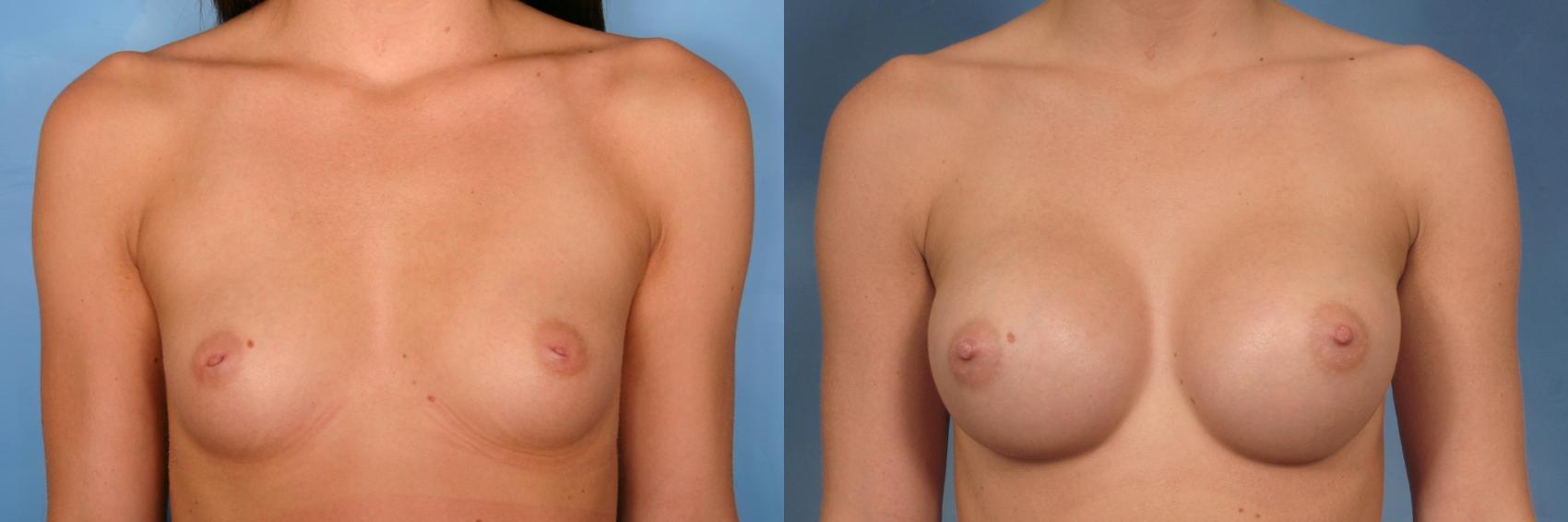 Before & After Breast Augmentation Case 98 View #1 View in Naples and Ft. Myers, FL