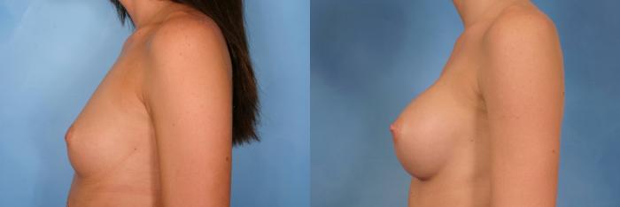 Before & After Breast Augmentation Case 98 View #3 View in Naples and Ft. Myers, FL