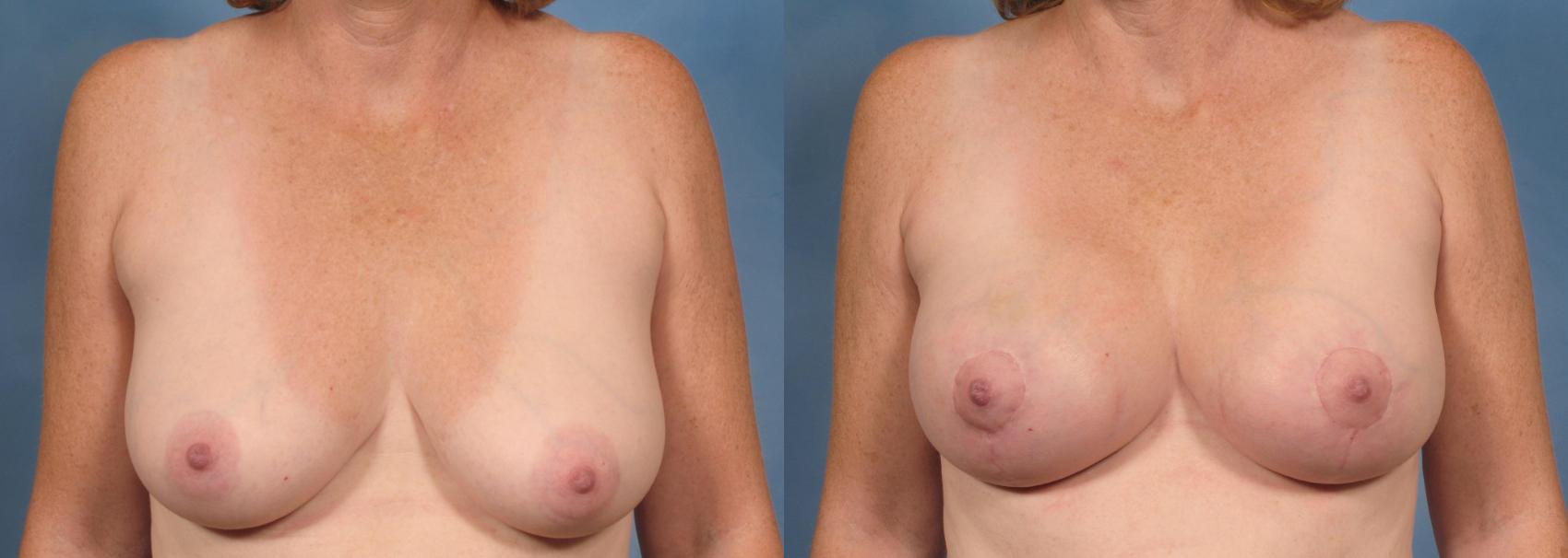 Before & After Breast Augmentation with Lift Case 100 View #1 View in Naples and Ft. Myers, FL