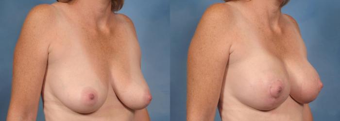 Before & After Breast Augmentation with Lift Case 100 View #2 View in Naples and Ft. Myers, FL
