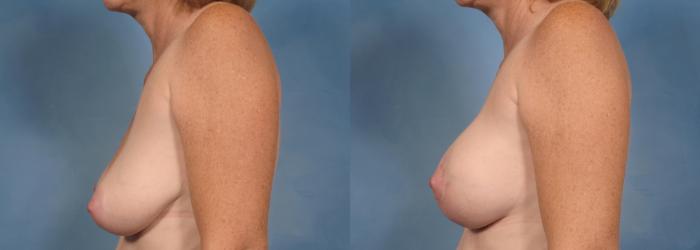 Before & After Breast Augmentation with Lift Case 100 View #3 View in Naples and Ft. Myers, FL