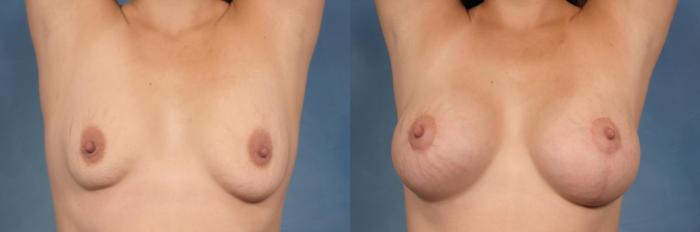 Before & After Breast Augmentation with Lift Case 107 View #2 View in Naples and Ft. Myers, FL