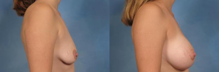 Before & After Breast Augmentation with Lift Case 107 View #4 View in Naples and Ft. Myers, FL