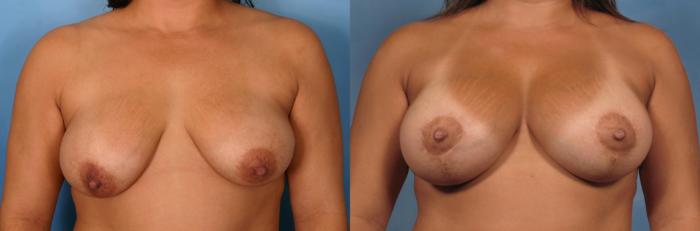 Before & After Breast Augmentation with Lift Case 118 View #1 View in Naples and Ft. Myers, FL