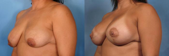Before & After Breast Augmentation with Lift Case 118 View #2 View in Naples and Ft. Myers, FL
