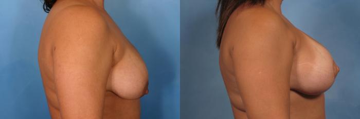 Before & After Breast Augmentation with Lift Case 118 View #3 View in Naples and Ft. Myers, FL