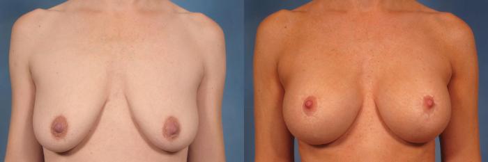 Before & After Breast Augmentation with Lift Case 135 View #1 View in Naples and Ft. Myers, FL