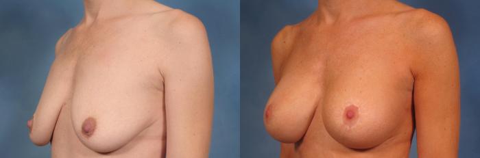 Before & After Breast Augmentation with Lift Case 135 View #3 View in Naples and Ft. Myers, FL