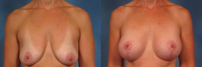 Before & After Breast Augmentation with Lift Case 203 View #1 View in Naples and Ft. Myers, FL