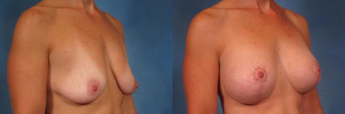 Before & After Breast Augmentation with Lift Case 203 View #2 View in Naples and Ft. Myers, FL