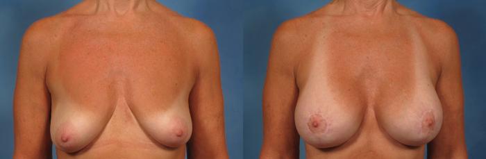 Before & After Breast Augmentation with Lift Case 252 View #1 View in Naples and Ft. Myers, FL