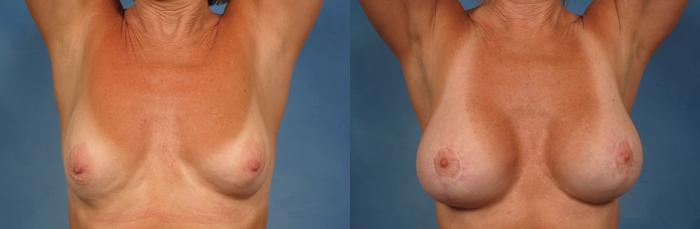 Before & After Breast Augmentation with Lift Case 252 View #2 View in Naples and Ft. Myers, FL