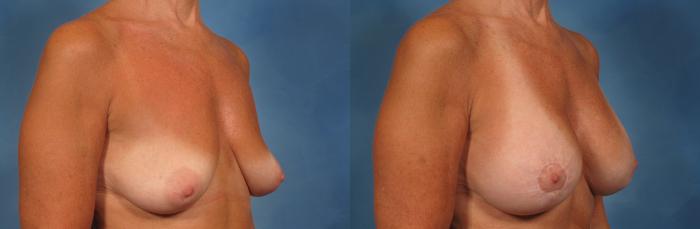 Before & After Breast Augmentation with Lift Case 252 View #3 View in Naples and Ft. Myers, FL