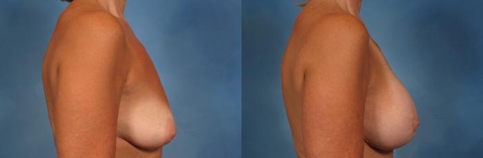 Before & After Breast Augmentation with Lift Case 252 View #4 View in Naples and Ft. Myers, FL