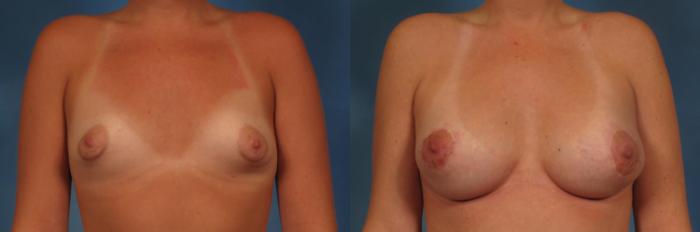 Before & After Breast Augmentation with Lift Case 255 View #1 View in Naples and Ft. Myers, FL