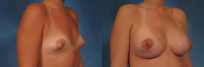 Before & After Breast Augmentation with Lift Case 255 View #5 View in Naples and Ft. Myers, FL