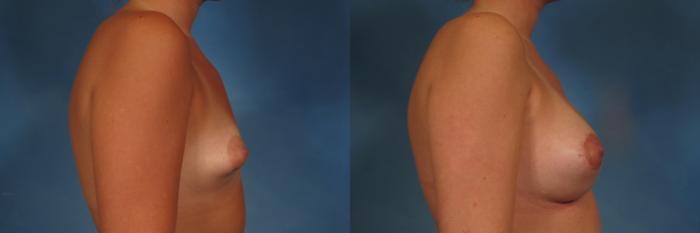 Before & After Breast Augmentation with Lift Case 255 View #6 View in Naples and Ft. Myers, FL