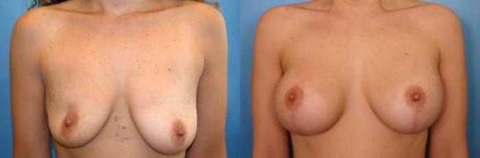 Before & After Breast Augmentation with Lift Case 4 View #1 View in Naples and Ft. Myers, FL