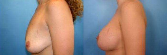 Before & After Breast Augmentation with Lift Case 4 View #2 View in Naples and Ft. Myers, FL