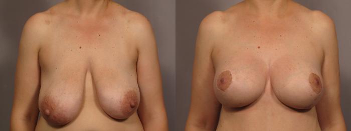 Before Breast Augmentation and Lift, Front View