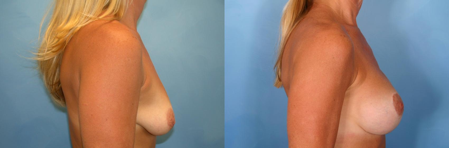 Before & After Breast Augmentation with Lift Case 5 View #1 View in Naples and Ft. Myers, FL