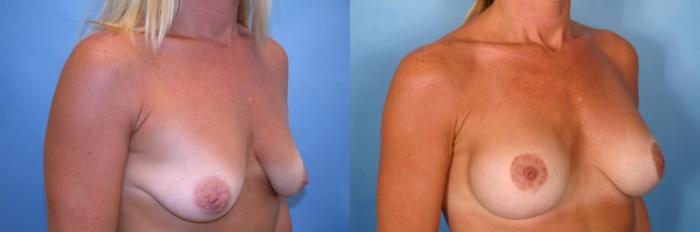 Before & After Breast Augmentation with Lift Case 5 View #2 View in Naples and Ft. Myers, FL