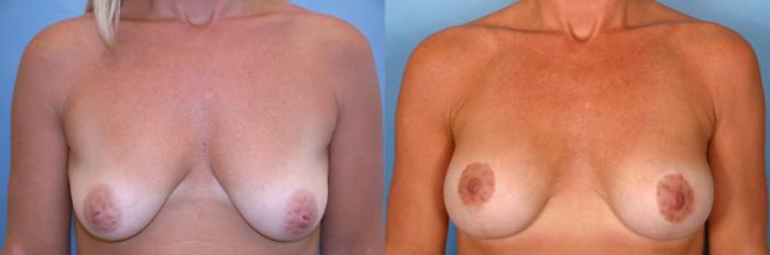 Before & After Breast Augmentation with Lift Case 5 View #5 View in Naples and Ft. Myers, FL