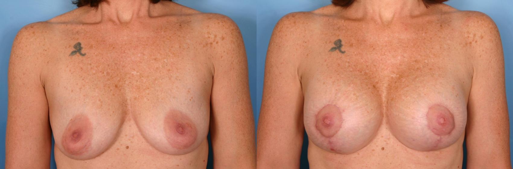Before & After Breast Augmentation with Lift Case 55 View #1 View in Naples and Ft. Myers, FL