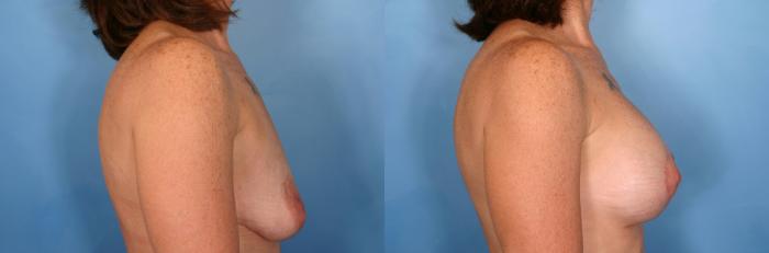 Before & After Breast Augmentation with Lift Case 55 View #2 View in Naples and Ft. Myers, FL