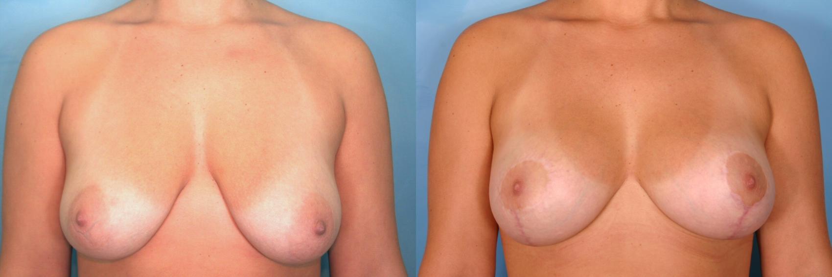 Before & After Breast Augmentation with Lift Case 56 View #1 View in Naples and Ft. Myers, FL