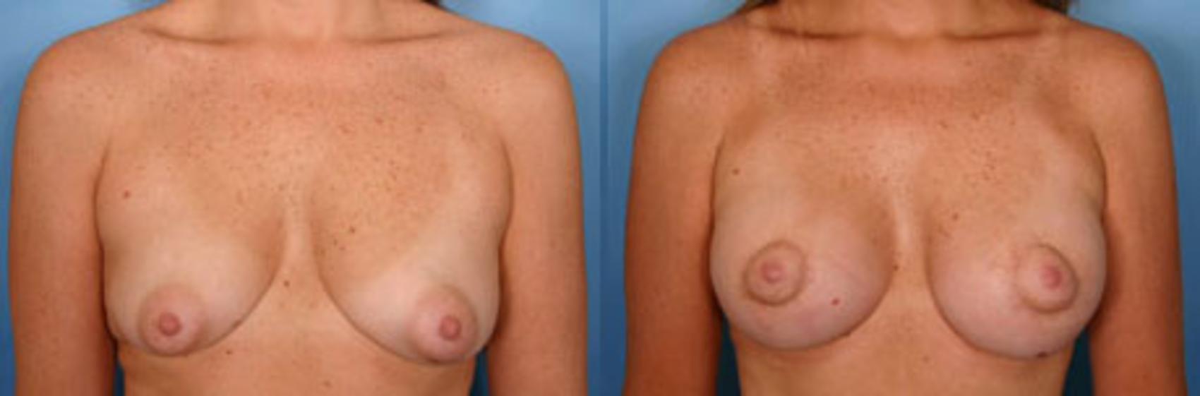 Before & After Breast Augmentation with Lift Case 6 View #1 View in Naples and Ft. Myers, FL