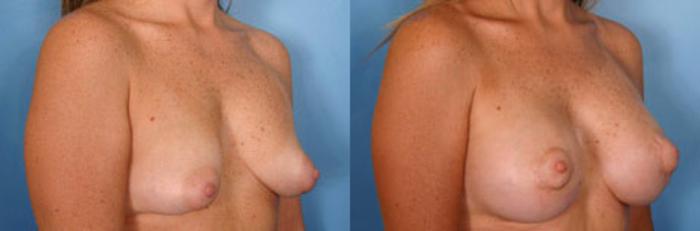 Before & After Breast Augmentation with Lift Case 6 View #2 View in Naples and Ft. Myers, FL