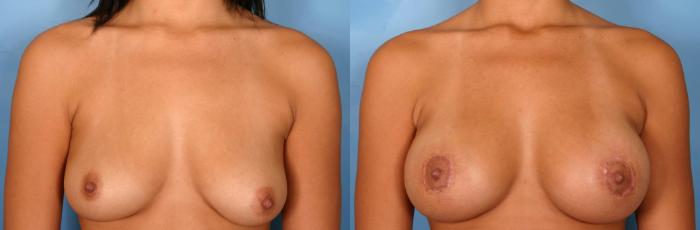 Before & After Breast Augmentation with Lift Case 73 View #1 View in Naples and Ft. Myers, FL